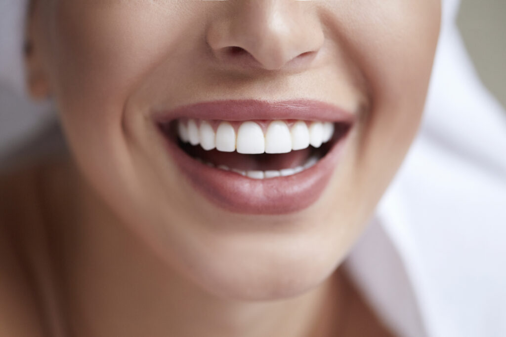 blanqueamiento dental
