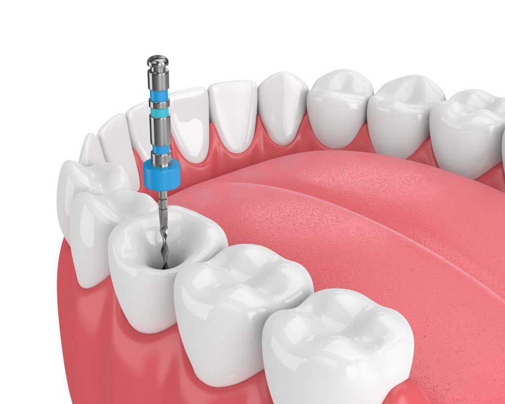 endodoncia