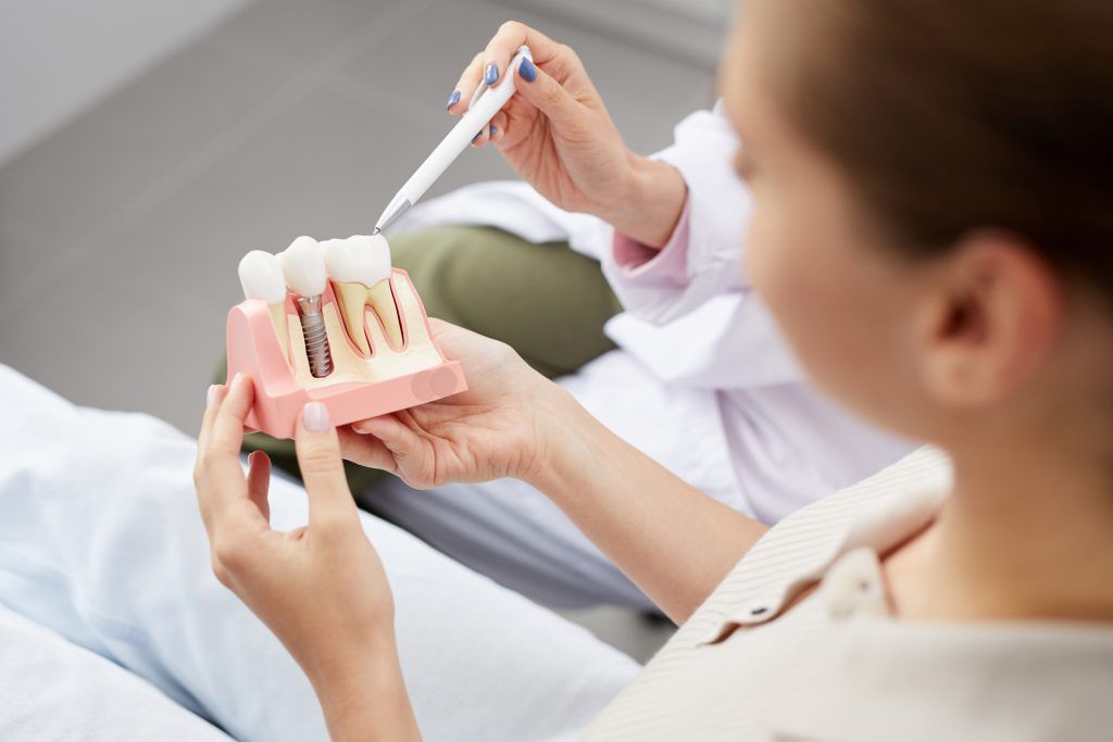 implantes dentales falsos mitos