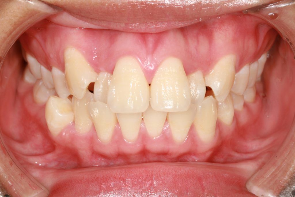 consecuencias maloclusión dental