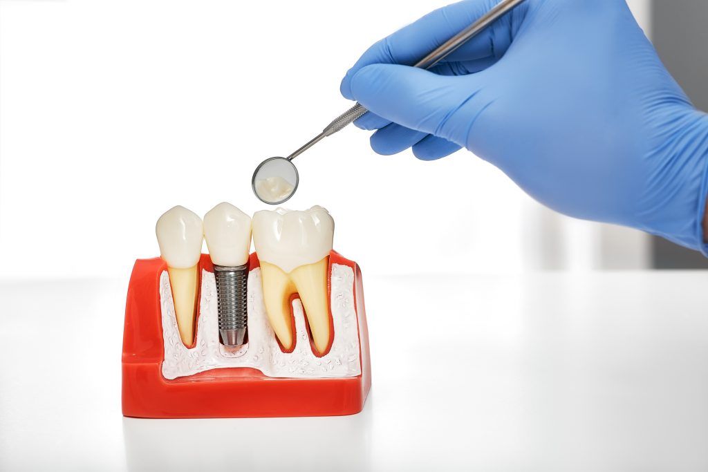implante dental puente
