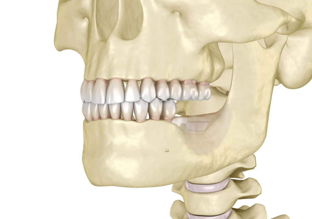 reabsorción ósea tras la pérdida dental
