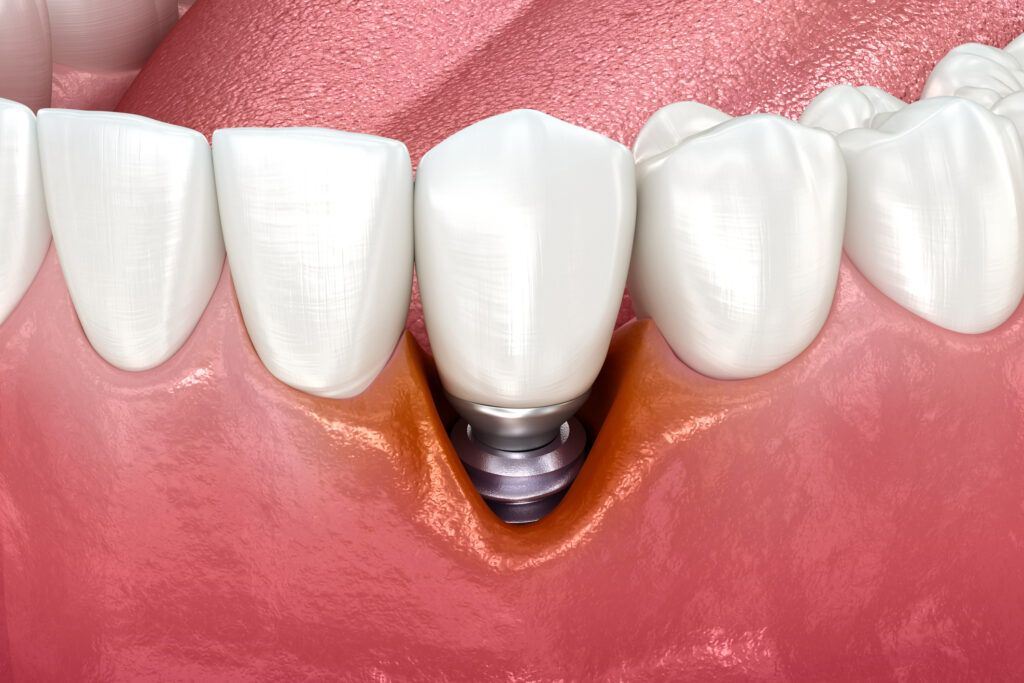 ¿Qué es la periimplantitis y cómo prevenirla?