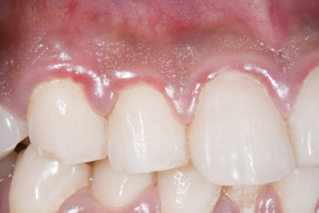 inflamación encías
