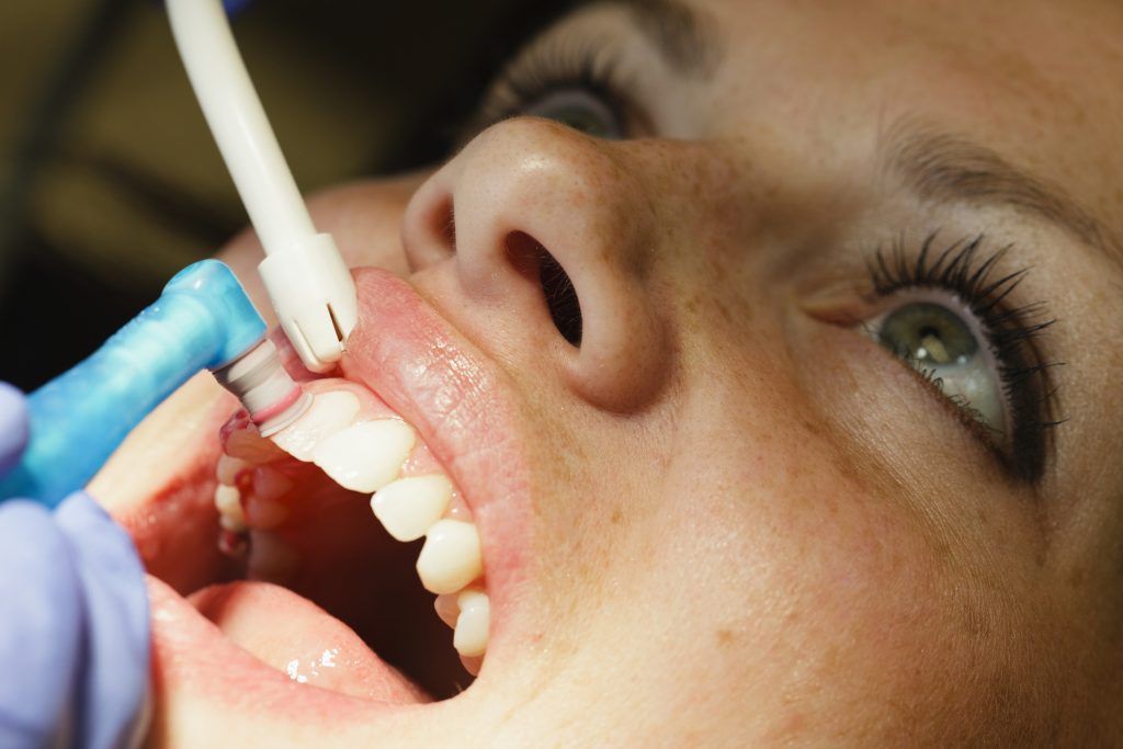 limpieza dental