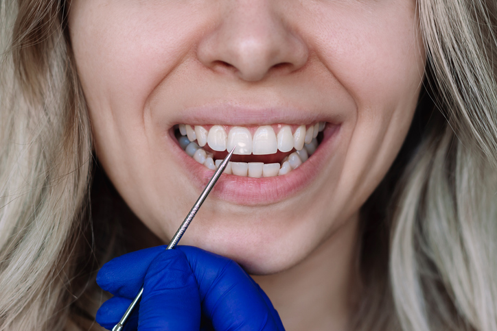manchas blancas en los dientes