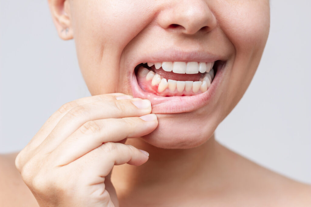 bolsas periodontales