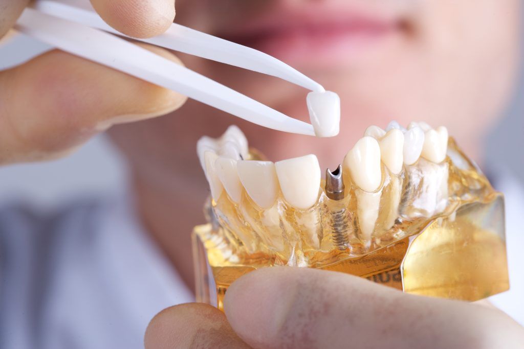 implantes dentales de carga inmediata en Don Benito