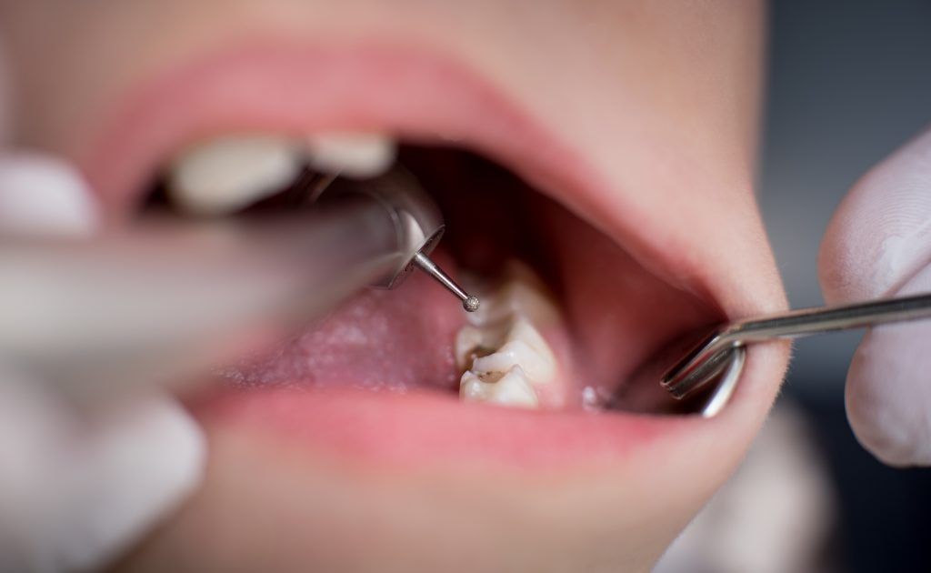 caries